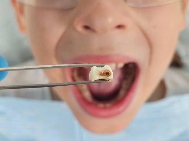 Best Knocked-Out Tooth (Avulsed Tooth) Treatment in Atoka, TN